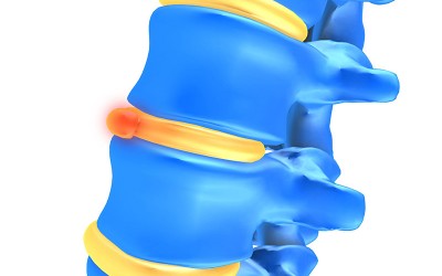 The Myth of the Slipped Disc