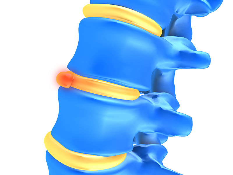 The Myth of the Slipped Disc